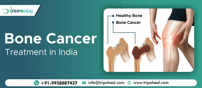 Bone Cancer Treatment in India: Advanced Care at Affordable Costs