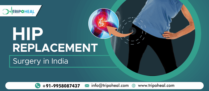 Hip Replacement Surgery in India