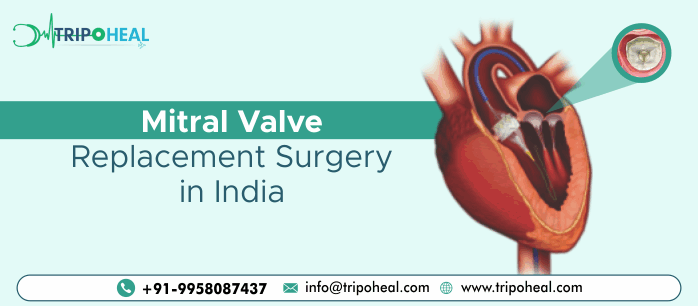 Mitral Valve Replacement Surgery In India