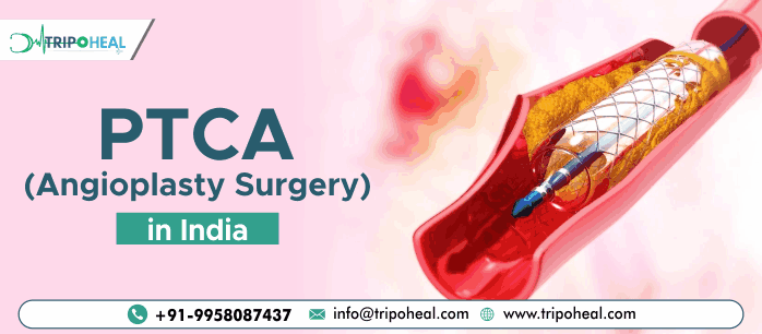 Angioplasty in India: Advanced Cardiac Care at Affordable Costs